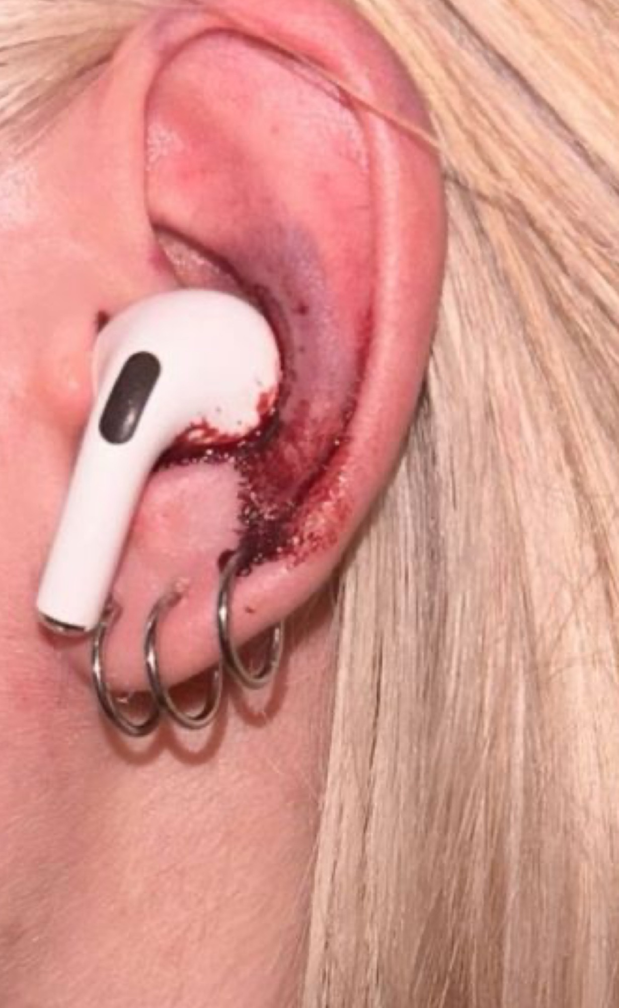 These are the consequences of using earbuds the wrong way…